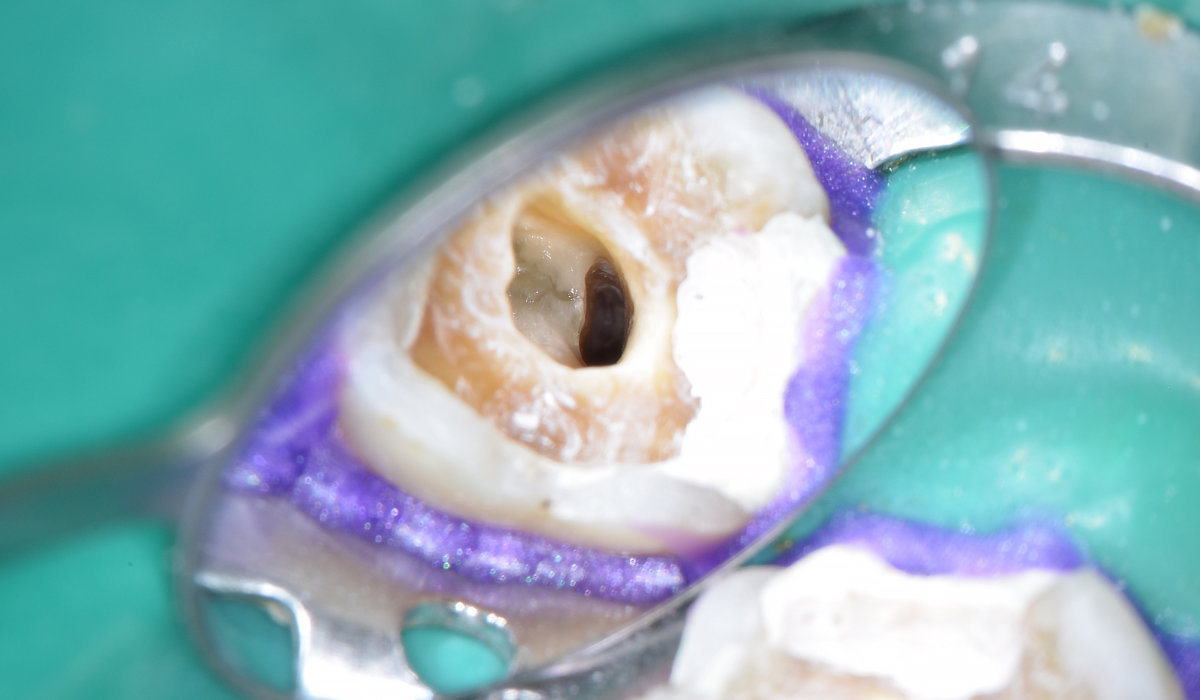 <img src" Flattened-Canals-2.jpg" alt="Clean molar distal after procedure using ultrasonic inserts"