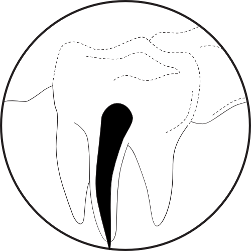<img src=" Illustration-Activating-Irrigation-1.png" alt="Root canals previously cleaned">