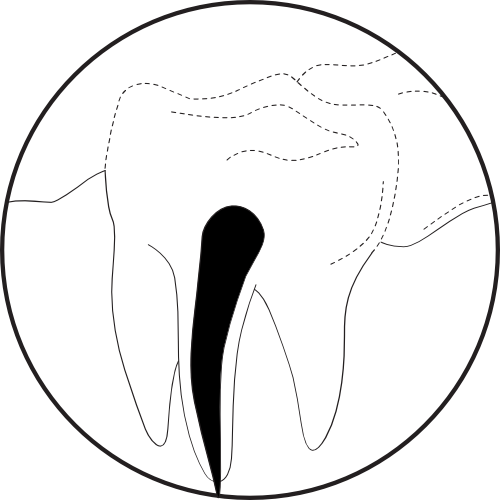 <img src="Illustration-Activating-Irrigation-1.png" alt=" Root canal ready to obturate">