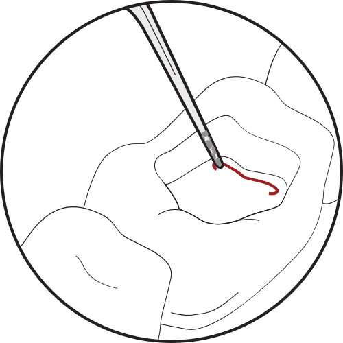 <img src="Illustration-Locating-Middle-Mesial-Canals-1.png" alt="Illustration of groove created connecting canals.">