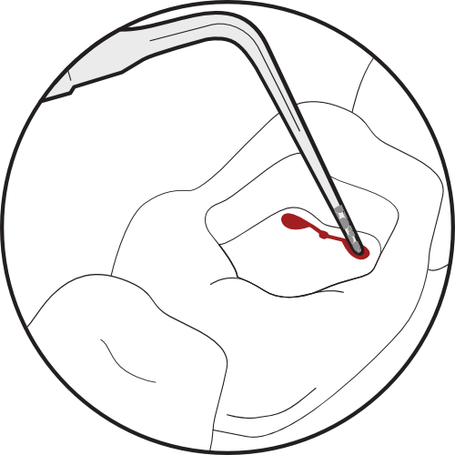 <img src= " Illustration-Locating-Middle-Mesial-Canals-2.png" alt="Illustration of locating the middle medial canal office.">