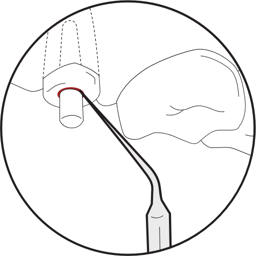 <img src="Illustration-Removing-Cast-Posts-3.png" alt="Removing the cement line using the E8 insert.">