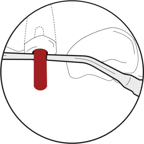 <img src="Illustration-Removing-Cast-Posts-4.png" alt="Removing cast post with both E12 tips.">