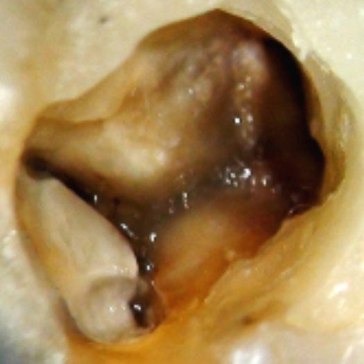 <img src="Images-Locating-Middle-Mesial-Canals-1.jpg" alt= Groove created to connect the mesiobuccal and mesiolingual canals.">