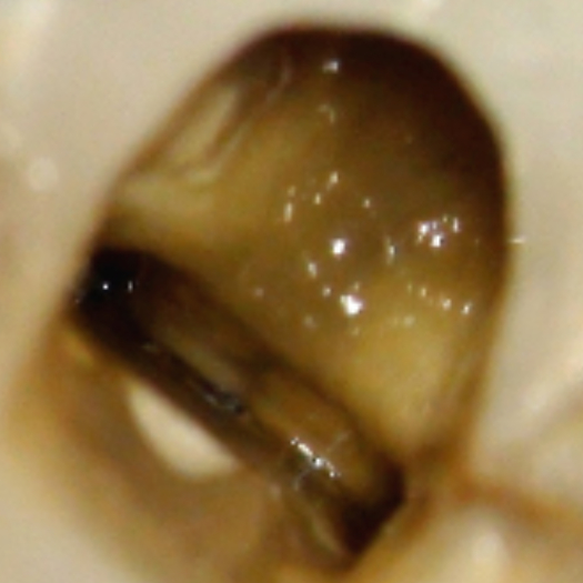 <img src="Locating-Middle-Mesial-Canals-2.jpg" alt="Middle Medial canal located using ultrasonic.">