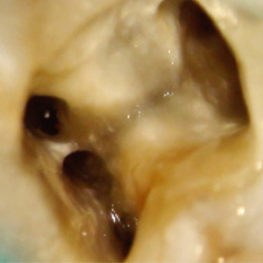 <img src=" Images-Locating-Middle-Mesial-Canals-3.jpg" alt="Final result of middle medial canal.">