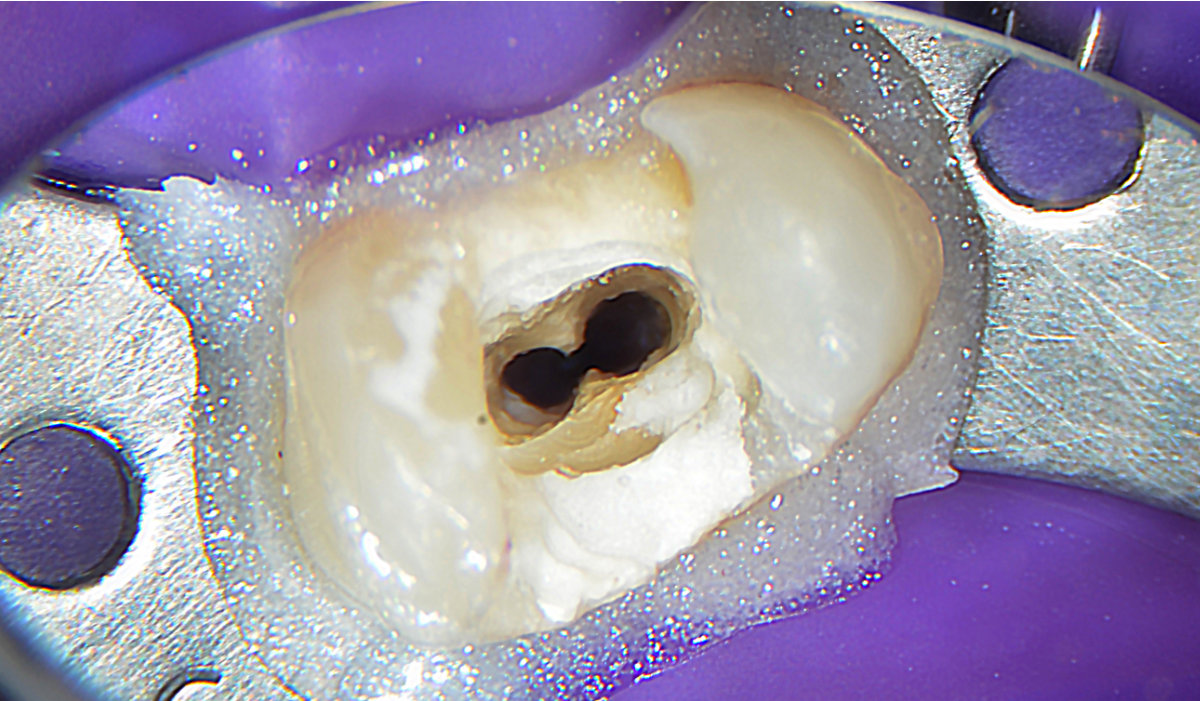 <img src=" Isthmus-1.jpg" alt="Cleaning Isthmus Premolar after preparation with traditional files.">