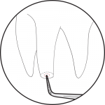 <img src=" Illustration-Apical-Surgery-2.png" alt="P1 line tip is chosen according to size and angle of canal.">